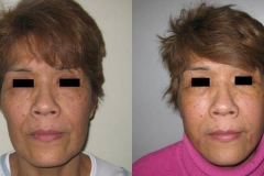 lifting-facciale-completo-donna-anni-59-id-1053