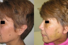 lifting-facciale-completo-donna-anni-59-id-1054