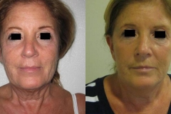 lifting-facciale-completo-donna-anni-61-id-1051