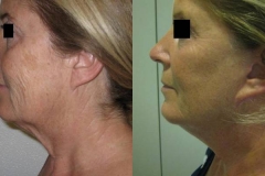 lifting-facciale-completo-donna-anni-61-id-1052