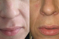 needling-natural-collagen-induction-donna-anni-33-id-567