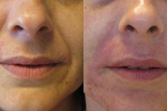 needling-natural-collagen-induction-donna-anni-37-id-1020