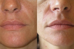 needling-natural-collagen-induction-donna-anni-41-id-1017