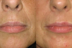 needling-natural-collagen-induction-donna-anni-47-id-570